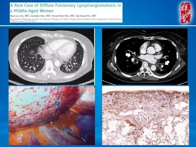 【病例】弥漫性肺淋巴管瘤病1例CT影像表现