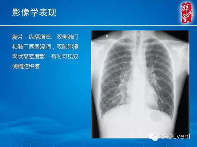 【病例】弥漫性肺淋巴管瘤病1例CT影像表现