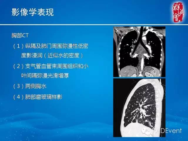 【病例】弥漫性肺淋巴管瘤病1例CT影像表现