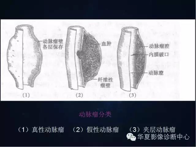【PPT】主动脉瘤的鉴别诊断