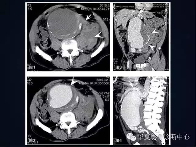 【PPT】主动脉瘤的鉴别诊断