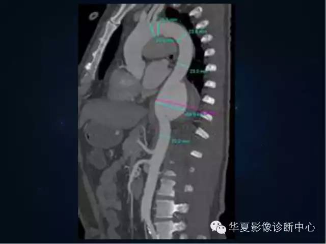 【PPT】主动脉瘤的鉴别诊断