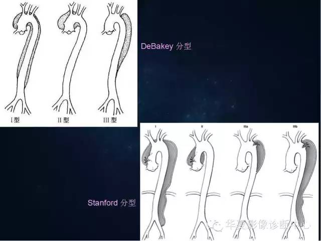 【PPT】主动脉瘤的鉴别诊断