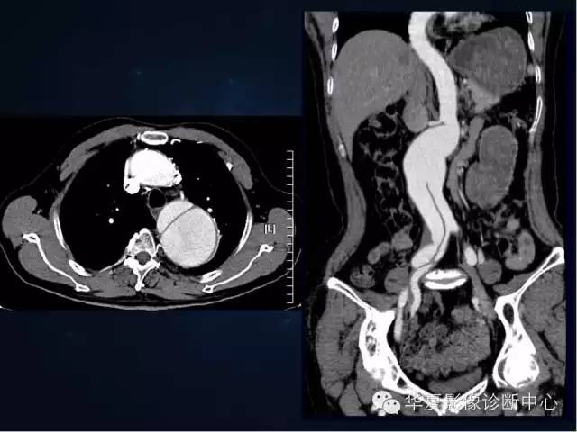 【PPT】主动脉瘤的鉴别诊断