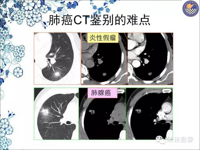 【PPT】肺癌CT高危征象解析