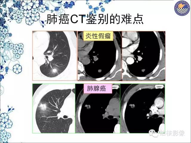 【PPT】肺癌CT高危征象解析