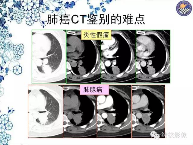 【PPT】肺癌CT高危征象解析