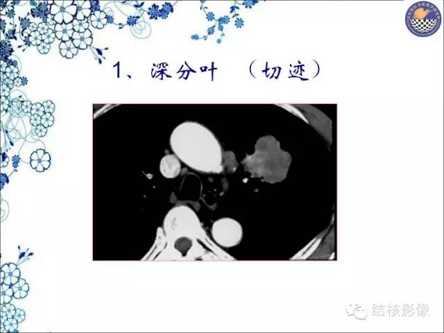 【PPT】肺癌CT高危征象解析