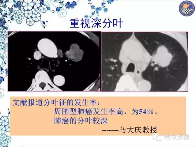 【PPT】肺癌CT高危征象解析