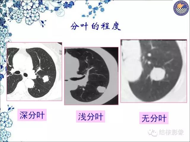 【PPT】肺癌CT高危征象解析
