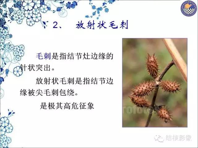 【PPT】肺癌CT高危征象解析