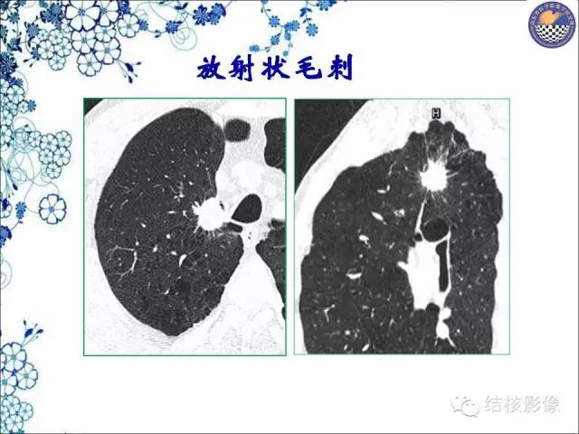 【PPT】肺癌CT高危征象解析