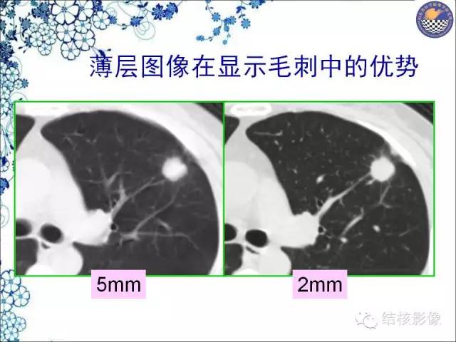 【PPT】肺癌CT高危征象解析