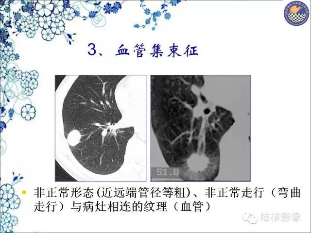 【PPT】肺癌CT高危征象解析