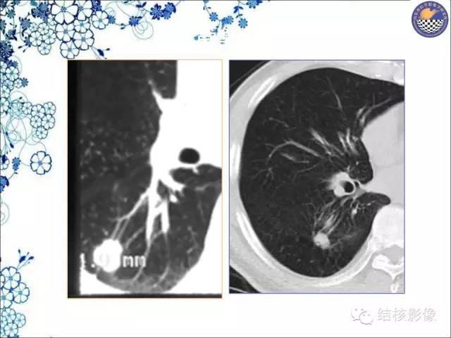 【PPT】肺癌CT高危征象解析