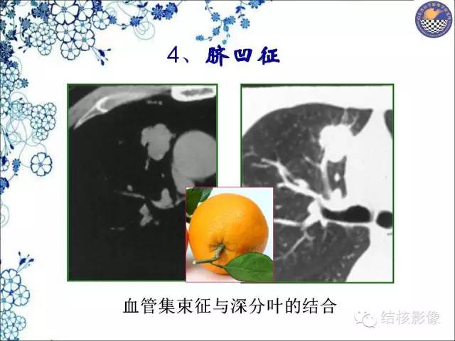 【PPT】肺癌CT高危征象解析