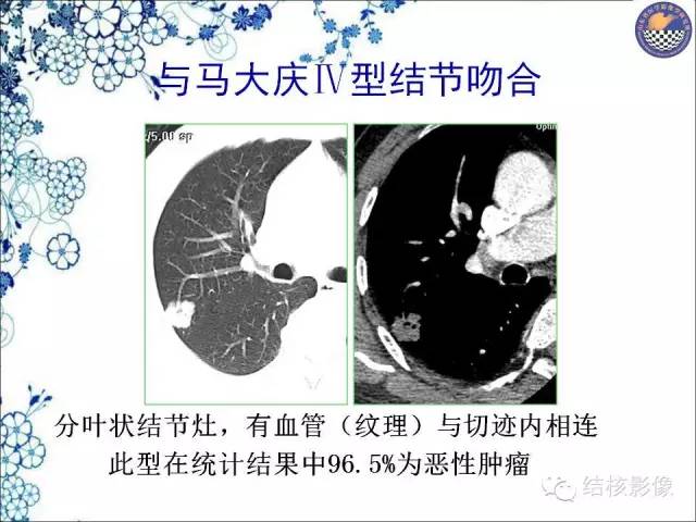 【PPT】肺癌CT高危征象解析
