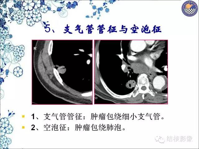 【PPT】肺癌CT高危征象解析