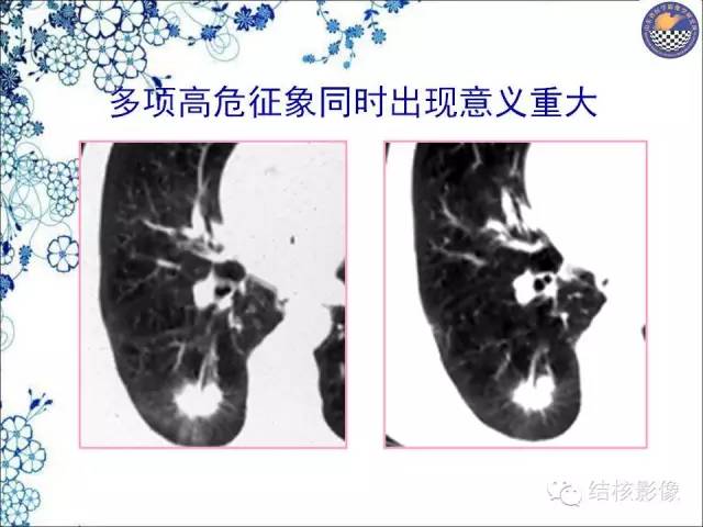 【PPT】肺癌CT高危征象解析