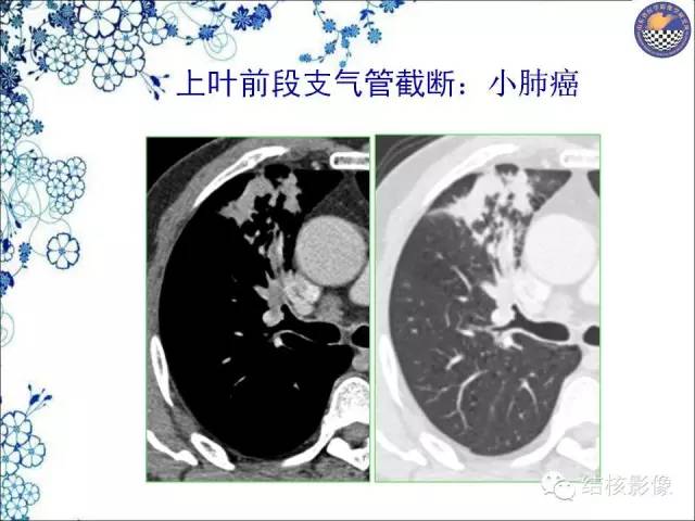 【PPT】肺癌CT高危征象解析