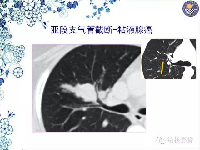 【PPT】肺癌CT高危征象解析
