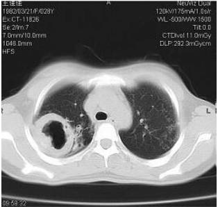 肺部空洞的鉴别诊断