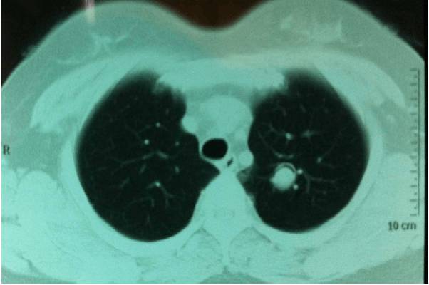 肺部空洞的鉴别诊断