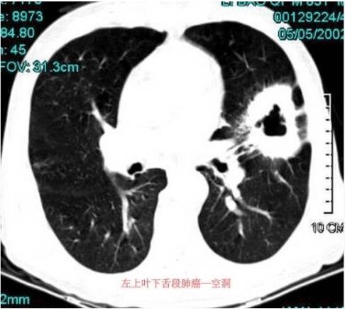 肺部空洞的鉴别诊断