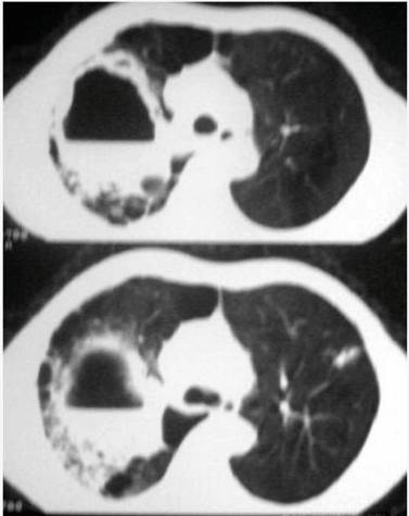 肺部空洞的鉴别诊断
