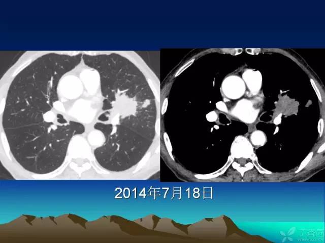【PPT】早期肺癌易漏诊征象分析