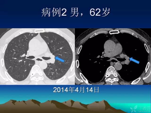 【PPT】早期肺癌易漏诊征象分析