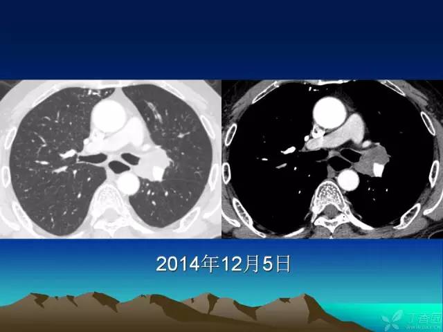 【PPT】早期肺癌易漏诊征象分析