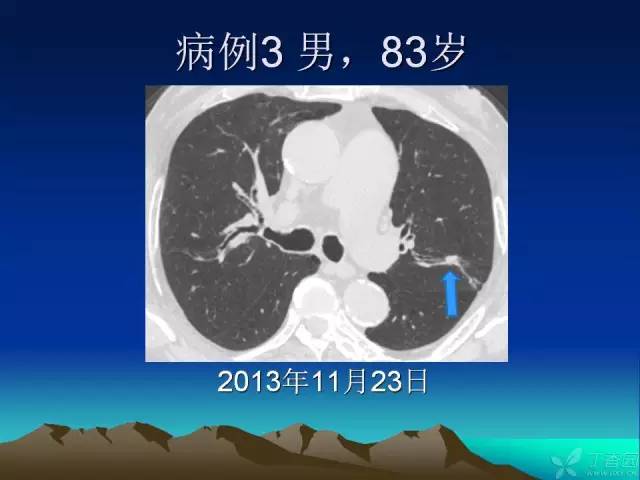 【PPT】早期肺癌易漏诊征象分析