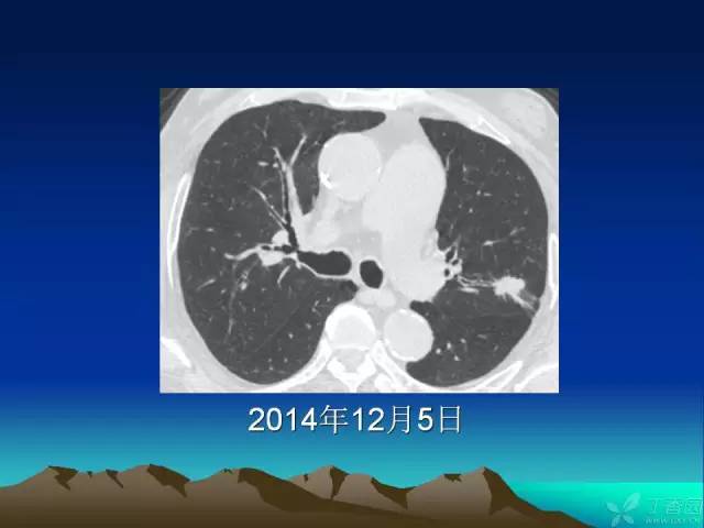 【PPT】早期肺癌易漏诊征象分析