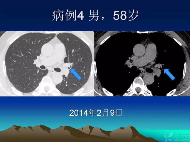 【PPT】早期肺癌易漏诊征象分析
