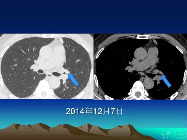 【PPT】早期肺癌易漏诊征象分析