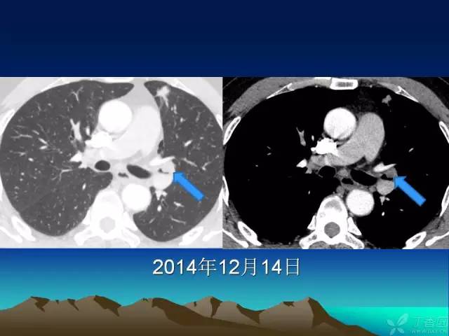 【PPT】早期肺癌易漏诊征象分析