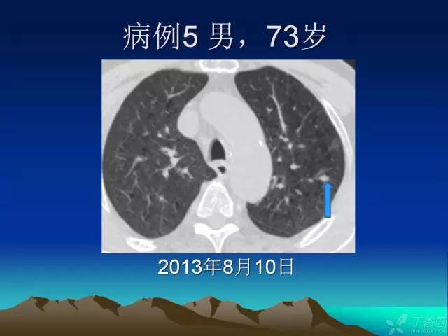 【PPT】早期肺癌易漏诊征象分析