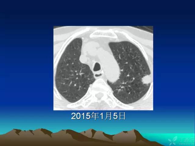 【PPT】早期肺癌易漏诊征象分析