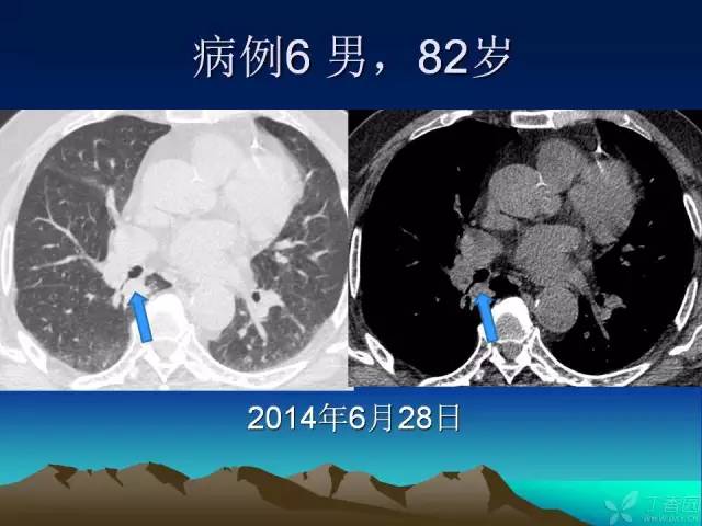 【PPT】早期肺癌易漏诊征象分析