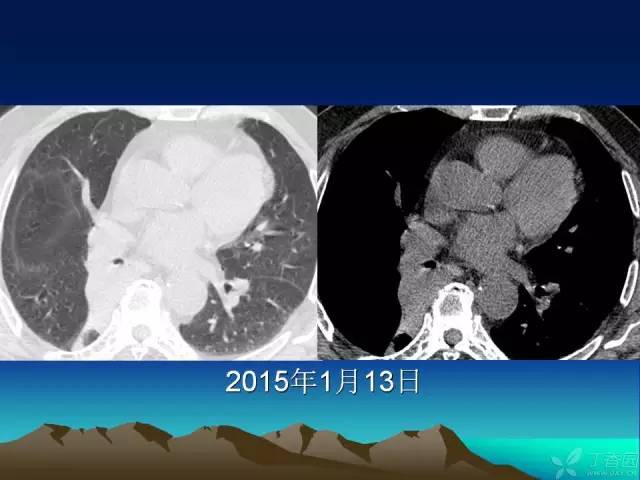 【PPT】早期肺癌易漏诊征象分析