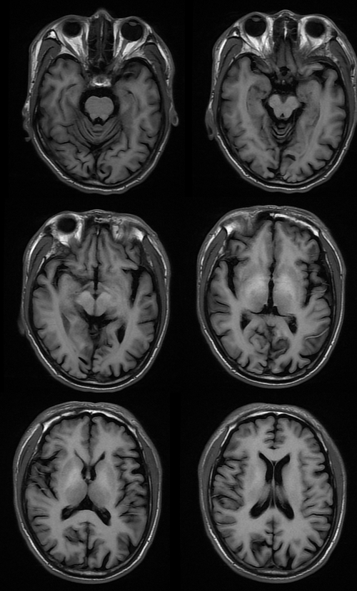 【病例】肝性脑病1例MR影像表现