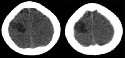 胚胎发育不良性神经上皮肿瘤DNET的影像表现