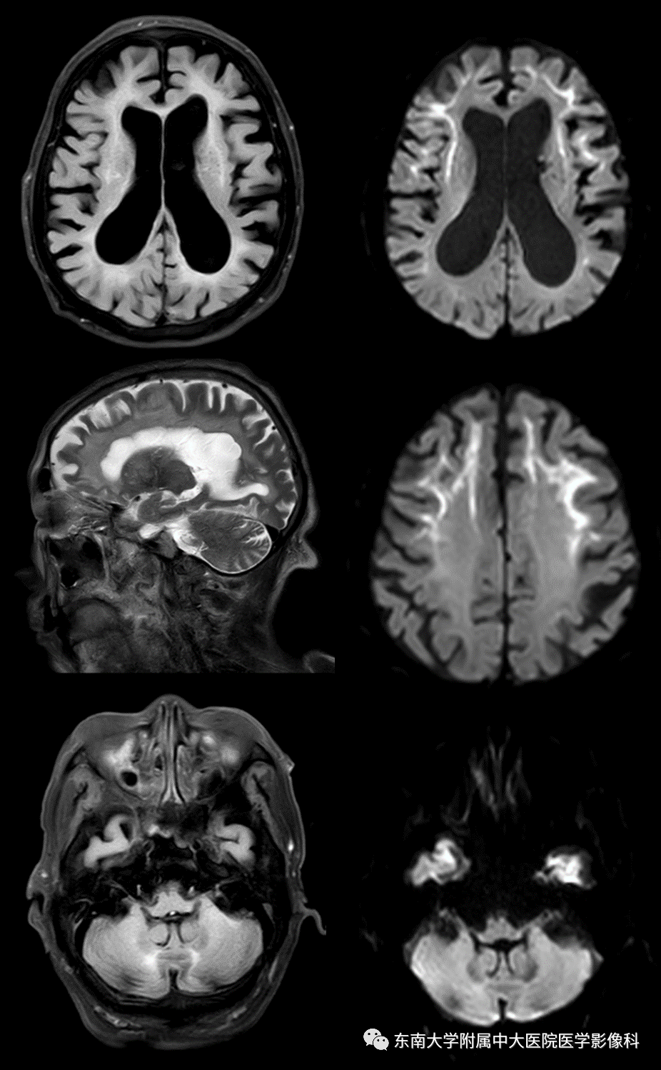 【PPT】神经元核内包涵体病（NIID）的影像学诊断