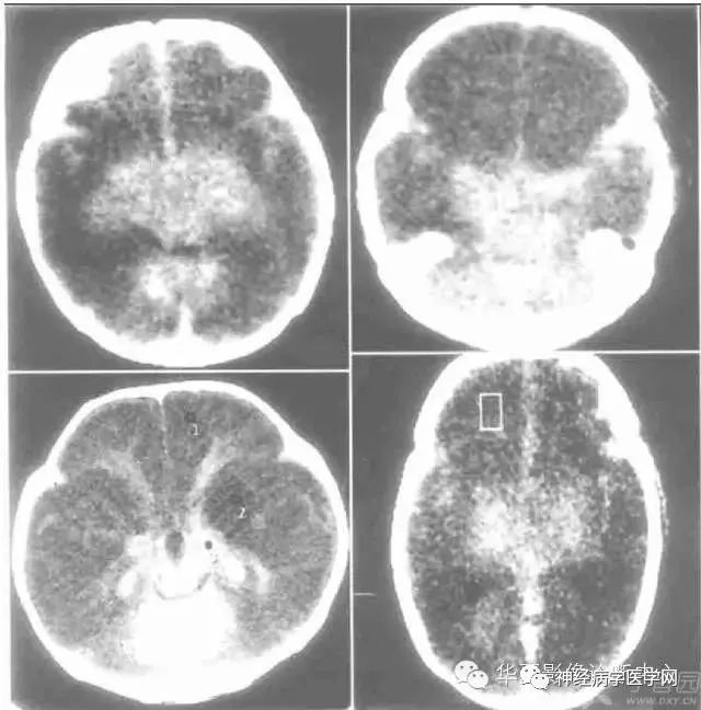 脑实质的“反转征”