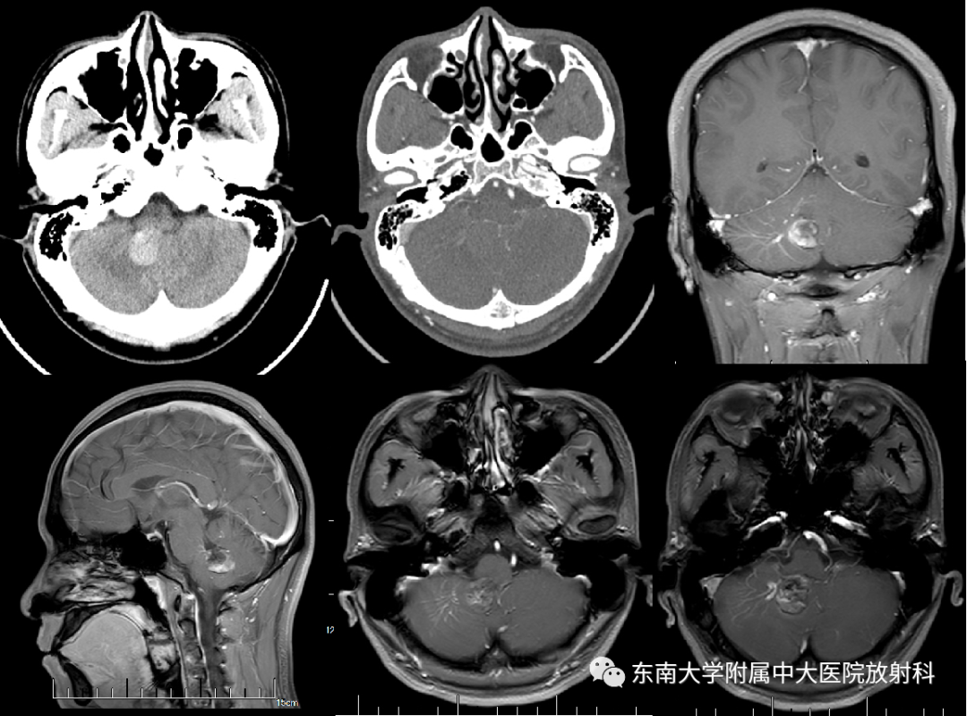 【PPT】颅内海绵状血管畸形