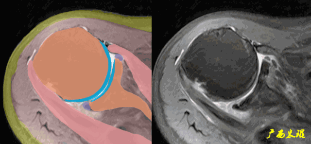 肩袖损伤的MRI诊断技巧