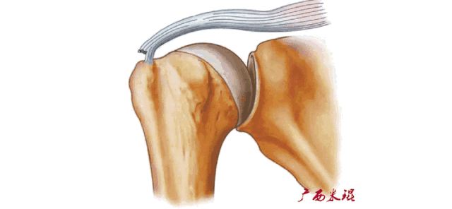 肩袖损伤的MRI诊断技巧