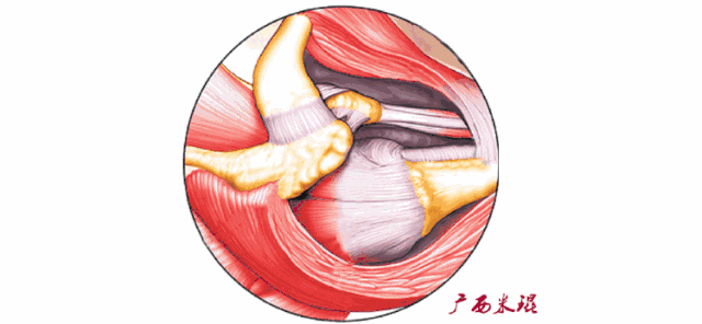 肩袖损伤的MRI诊断技巧