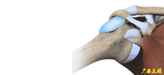 肩袖损伤的MRI诊断技巧